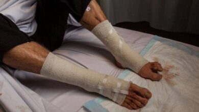 Sea Lice Chews Up Teenager's Legs in Australia 3 Flesh eating live 940x542